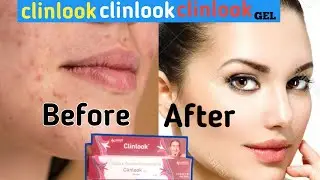 CLINLOOK GEL(face gel)#viral #ytshorts #medicine