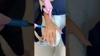 HAND HYDRATION AND REJUVENATION 🔥#botox #beauty #hand #hydration #skinbooster #skincareproducts