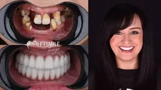ANTALYTA DENTAL IMPLANT |&nbsp;ALL ON SIX IMPLANT | ALL ON FOUR IMPLANT | LETSMILE TURKIYE | ANTALYA
