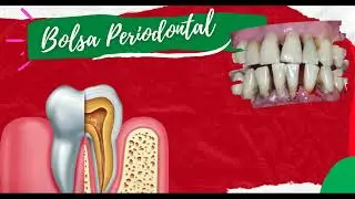 Bolsa Periodontal