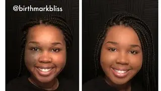 Birthmark Coverage