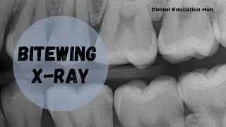 Bitewing X-ray | Intraoral Dental Radiograph