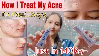 ACNE TREATMENT AT HOME | Eid Special Skincare