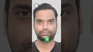 Remarkable Hair Transplant Result | Best Hair Transplant Before and After in India #hairtransplant