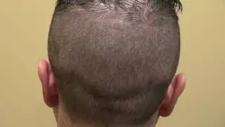 Dr. Diep FUE Scar Reviews Hair Transplant Bald Hair Loss Surgery Treatment  