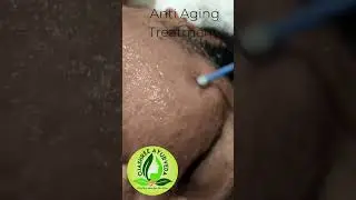 RF Anti Aging Treatment&hellip; collagen Remodeling.. reduction of fine lines & wrinkles