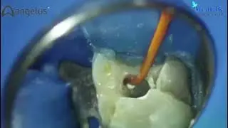 BIO-C Sealer by Angelus | Bio ceramic Root Canal Sealer