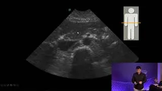 Rapid Ultrasound for Shock and Hypotension (RUSH) - IVC Excerpt