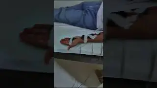 TENS Machine for Carpal Tunnel syndrome #cts #Tens #doctor #physiotherapy #hospital #paras #cts