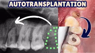 Replacing Premolars with Wisdom Teeth - Auto Transplantation by a GDP! - PDP193