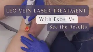 Leg Vein Laser Treatment with Excel V+ See The Results