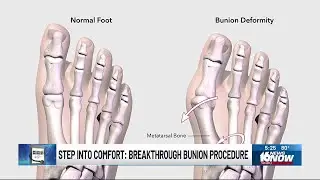 Medical Moment: Lapiplasty bunion procedure