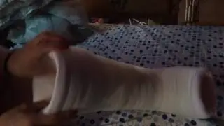 Removable Leg Cast