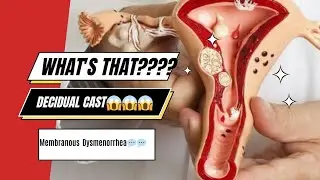 Decidual Cast | Period | flesh in your period? #menses #women #periods