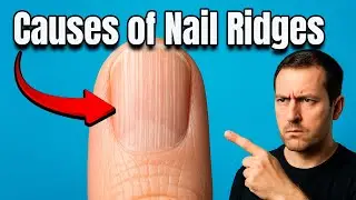 Ridges on Nails? Hidden Causes Your Doctor Might Miss!