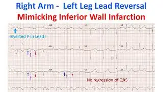 Right Arm -  Left Leg Lead Reversal Mimicking Inferior Wall Infarction