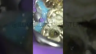 Cracked Tooth Discovery (Molar Root Canal)