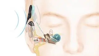 How Cochlear&trade; Hybrid&trade; Hearing Works