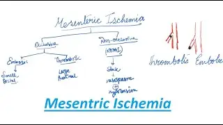 Mesenteric Ischemia | General Surgery Lecture | MBBS /MS /DNB |