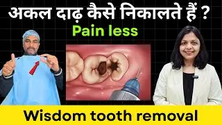 अकल दाढ़ कैसे निकालते हैं? | Painless Wisdom Tooth Removal LIVE Procedure #wisdom #tooth #removal