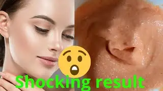 Best solution face pack for dark spot, pigmentation, Marks, melasma || Peachyblush