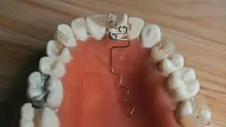 Orthodontic ((Z - spring))