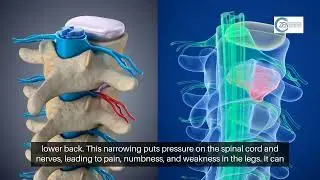 Secrets Exposed: Lumbar Spinal Stenosis in Mansfield, Tx Uncovered!