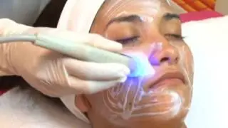 Radiofrecuencia Facial o Lifting sin cirugía