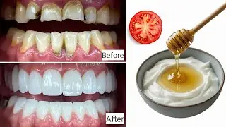 I Tried This Natural Teeth Whitening Trick &ndash; Shocking Results!