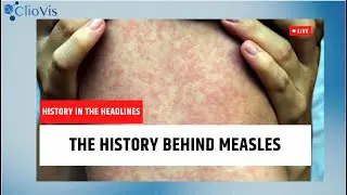 The History Behind Measles: History in the Headlines