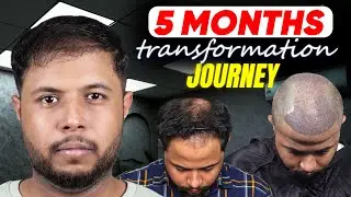Best Hair Transplant in Indore (HX-XZAX) | Best Results & Cost of Hair Transplant in Indore.