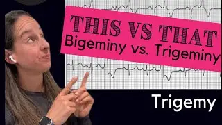 Bigeminy vs Trigeminy 🫀