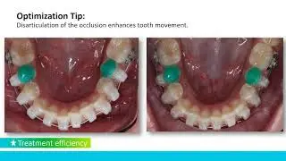 Engaging with Self-Ligation Achieving your goals with low force and light wires