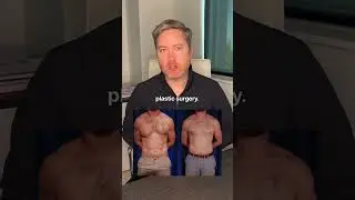 Gynecomastia Surgery for Men