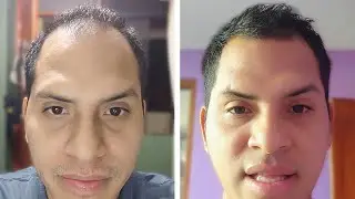 Microdosis De Finasteride Para Recuperar El Pelo