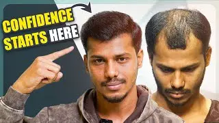 See the Amazing 4-Month Results 😍 | Hair Transplant in Kolkata | New Roots