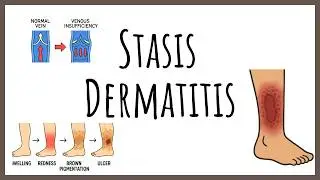 Stasis Dermatitis Made Simple | Causes, Symptoms & Treatment Explained