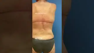 Bra Line Back Lift #backliftsurgery #backlift #looseskin