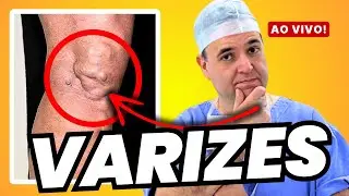 🔴 VARIZES nas PERNAS (má circulação) - AO VIVO com Dr. Alex Dornelles