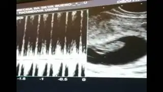 Nosso milagre - 8 semanas