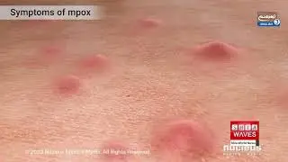 WHO says mpox remains a public health emergency of international concern