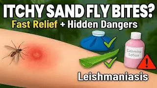 🦟 How to Treat Sandfly Bites FAST | Home Remedies, Prevention & Leishmaniasis Explained!