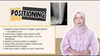 PACEMAN FOR LEFT LATERAL DISTAL FEMUR (TUMOR)