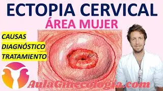 ECTOPIA CERVICAL: DEFINICI&Oacute;N, S&Iacute;NTOMAS, DIAGN&Oacute;STICO, TRATAMIENTO...