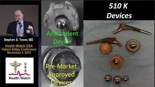 Complications of Wear or Corrosion of Chrome-Cobalt Hip Implants