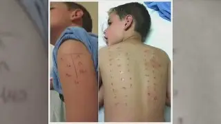 Epipen price hike