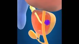 Prostate Cancer Surgery