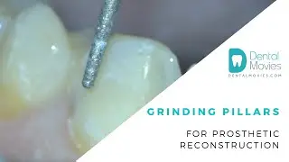 Grinding pillars for prosthetic reconstruction