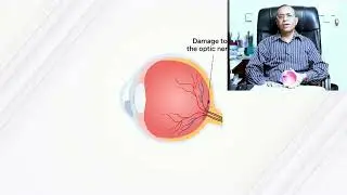 ग्लूकोमा (काला मोतिया) क्या है? | Silent Vision Killer | Best Eye Doctor in Lucknow