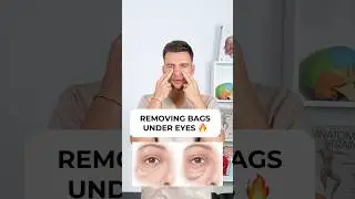 УДАЛЕНИЕ МЕШКОВ ПОД ГЛАЗАМИ❤️&zwj;🔥 #темныекругиподглазами #мешкиподглазами #мешкиподглазами #морщины...